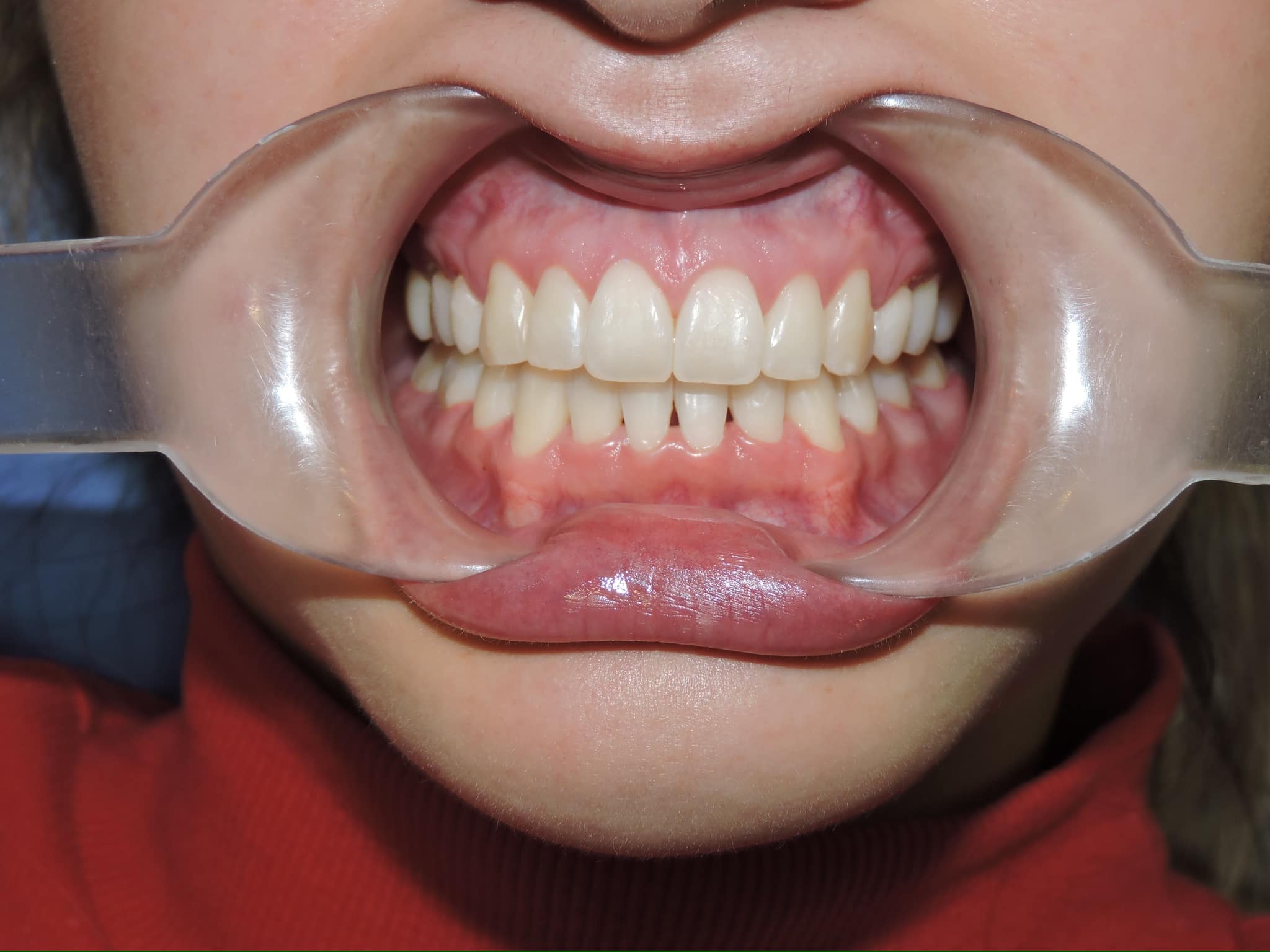 Caso de éxito B-ORTHODONTICS-2